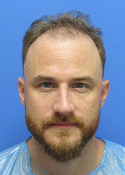 Male Hair Transplant Before & After Gallery - Patient 331308 - Image 1