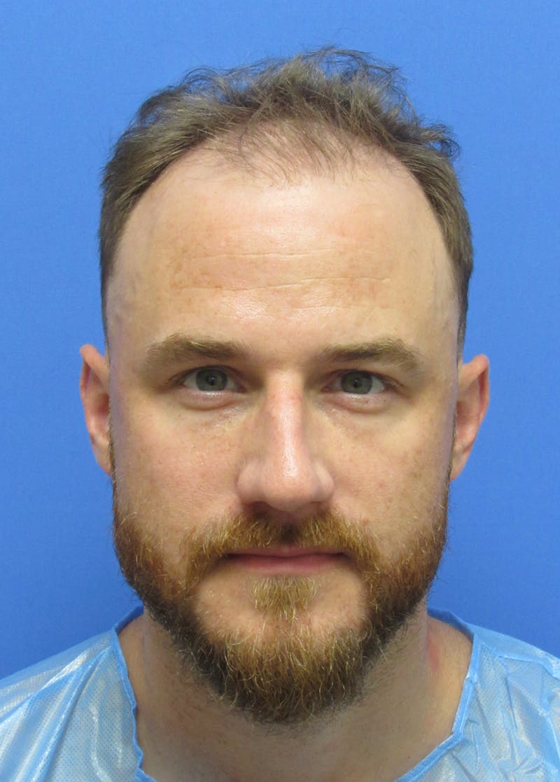 Male Hair Transplant Before & After Gallery - Patient 331308 - Image 1