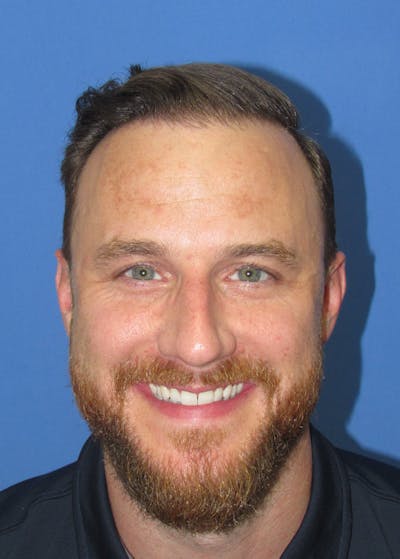 Male Hair Transplant Before & After Gallery - Patient 331308 - Image 2