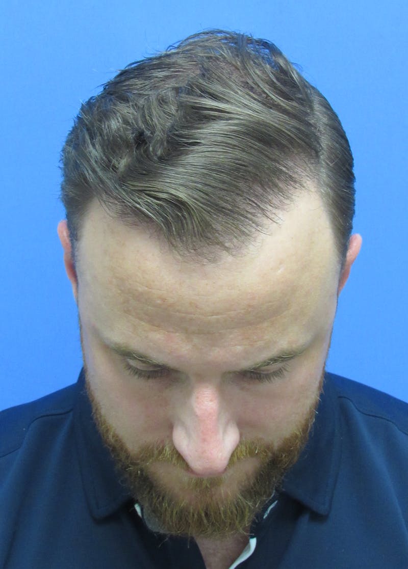 Male Hair Transplant Before & After Gallery - Patient 331308 - Image 4