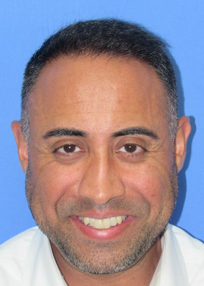 Male Hair Transplant Before & After Gallery - Patient 236214 - Image 2