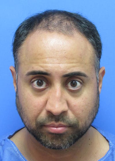 Male Hair Transplant Before & After Gallery - Patient 236214 - Image 1