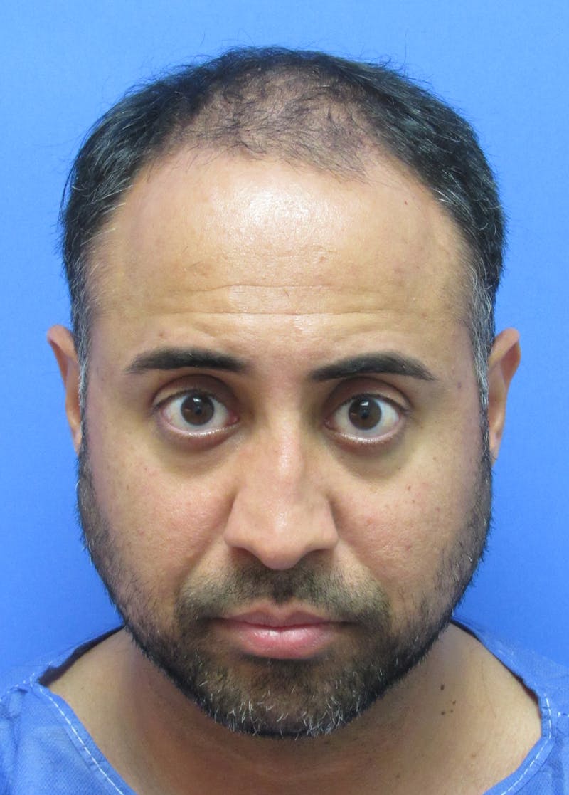 Male Hair Transplant Before & After Gallery - Patient 236214 - Image 1