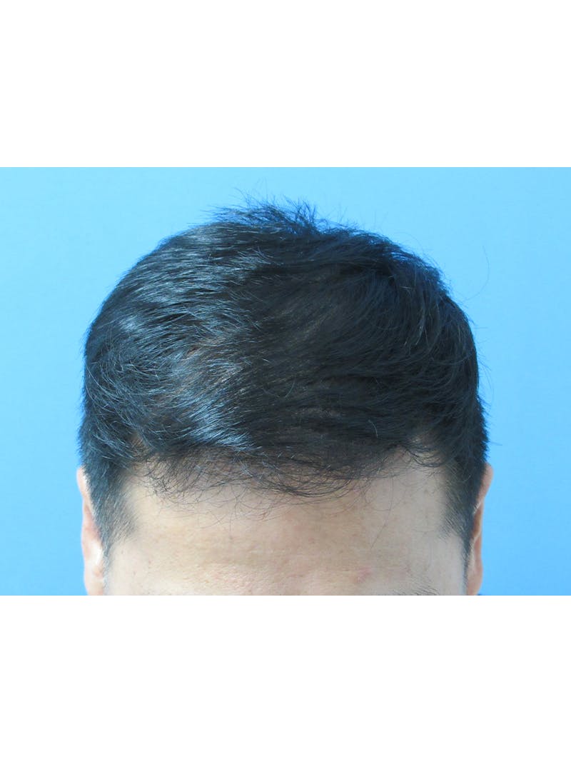 Male Hair Transplant Before & After Gallery - Patient 232158 - Image 4