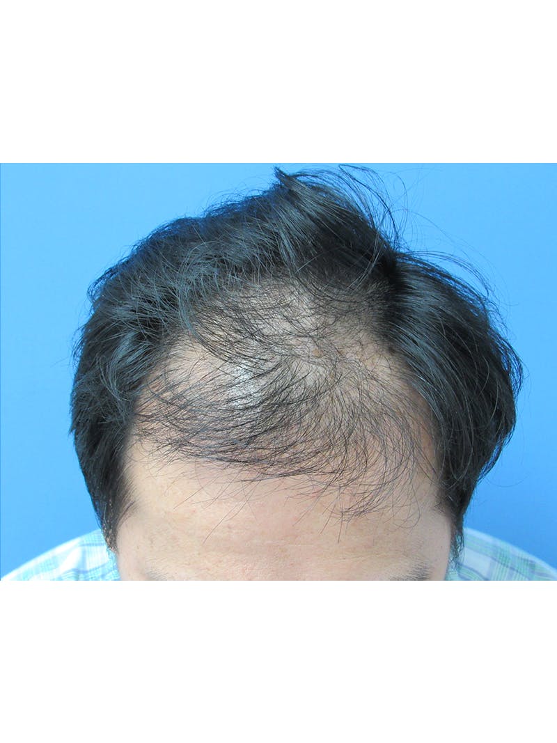 Male Hair Transplant Before & After Gallery - Patient 232158 - Image 3