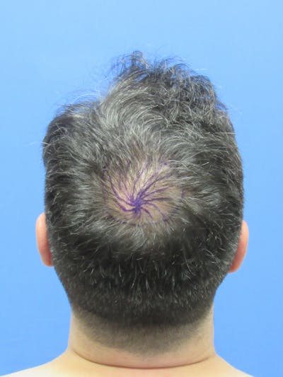 Male Hair Transplant Before & After Gallery - Patient 259967 - Image 1