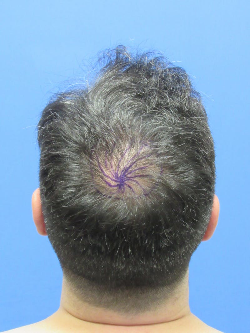 Male Hair Transplant Before & After Gallery - Patient 259967 - Image 1