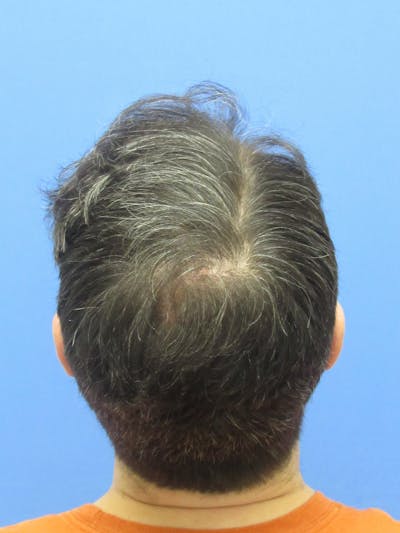 Male Hair Transplant Before & After Gallery - Patient 259967 - Image 2
