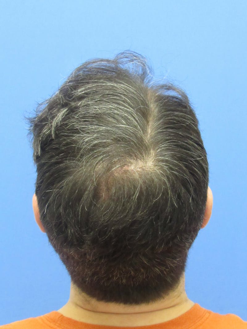 Male Hair Transplant Before & After Gallery - Patient 259967 - Image 2