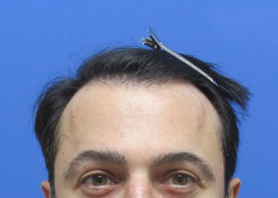 Eyebrow Transplant Before & After Gallery - Patient 373442 - Image 2