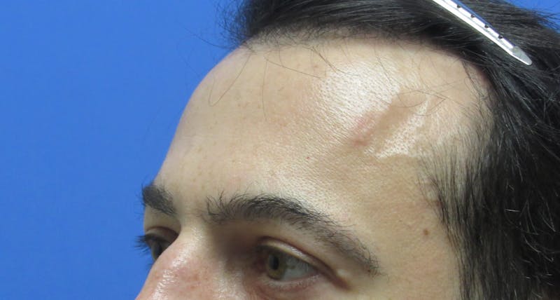 Eyebrow Transplant Before & After Gallery - Patient 373442 - Image 4