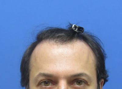 Eyebrow Transplant Before & After Gallery - Patient 373442 - Image 1