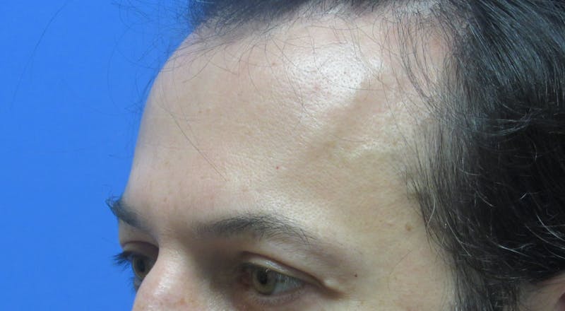 Eyebrow Transplant Before & After Gallery - Patient 373442 - Image 3
