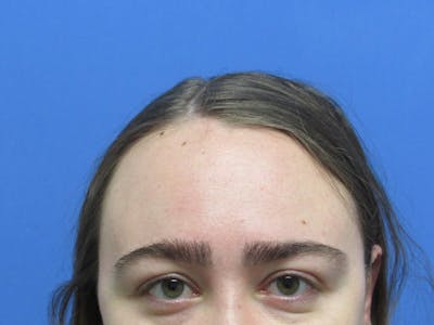 Eyebrow Transplant Before & After Gallery - Patient 366986 - Image 2