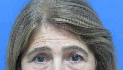 Eyebrow Transplant Before & After Gallery - Patient 416010 - Image 2