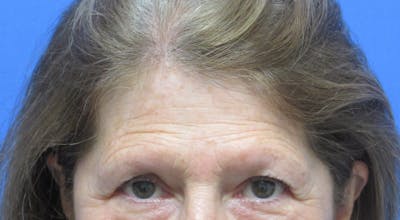 Eyebrow Transplant Before & After Gallery - Patient 416010 - Image 1