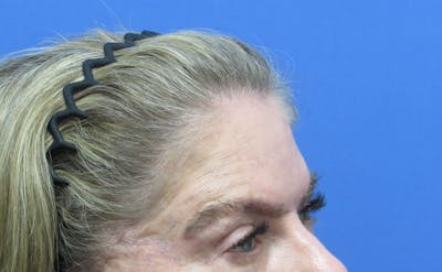 Eyebrow Transplant Before & After Gallery - Patient 242147 - Image 2