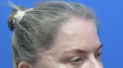 Eyebrow Transplant Before & After Gallery - Patient 242147 - Image 1