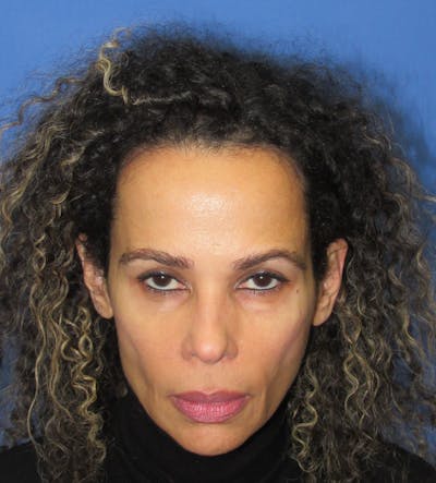 Eyebrow Transplant Before & After Gallery - Patient 208408 - Image 2