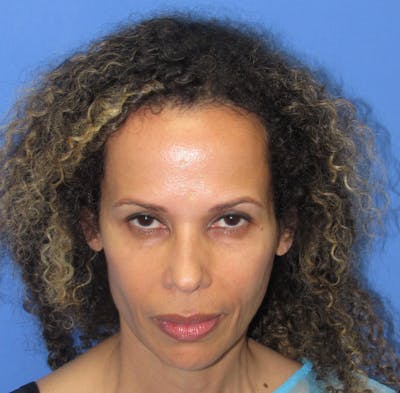 Eyebrow Transplant Before & After Gallery - Patient 208408 - Image 1