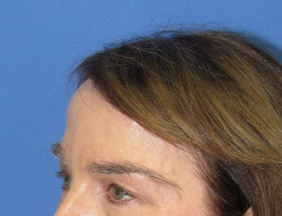 Eyebrow Transplant Before & After Gallery - Patient 179157 - Image 2