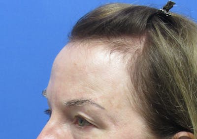 Eyebrow Transplant Before & After Gallery - Patient 179157 - Image 1