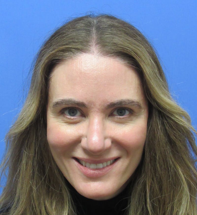Eyebrow Transplant Before & After Gallery - Patient 277590 - Image 4