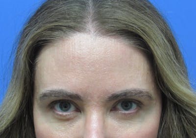 Eyebrow Transplant Before & After Gallery - Patient 277590 - Image 2