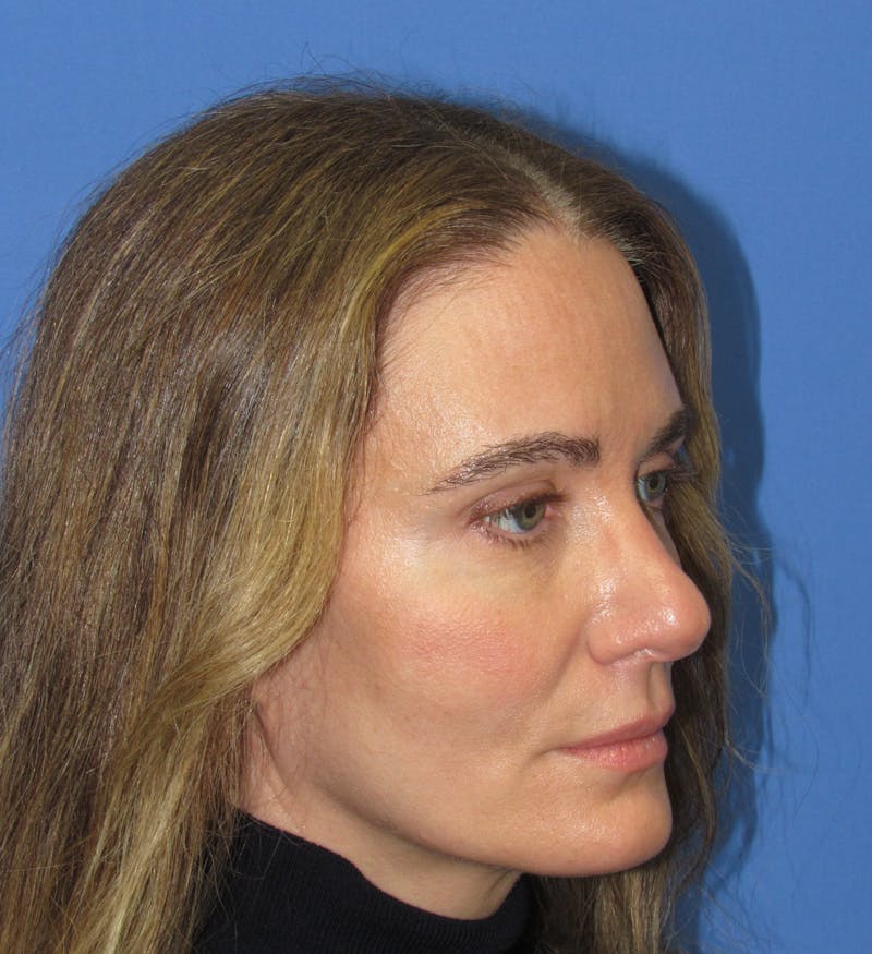 Eyebrow Transplant Before & After Gallery - Patient 277590 - Image 6