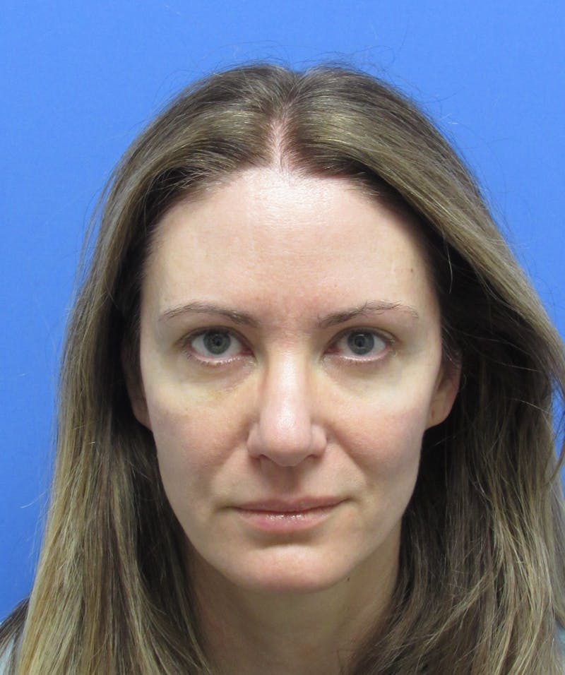 Eyebrow Transplant Before & After Gallery - Patient 277590 - Image 3