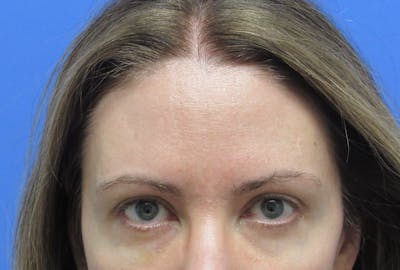 Eyebrow Transplant Before & After Gallery - Patient 277590 - Image 1