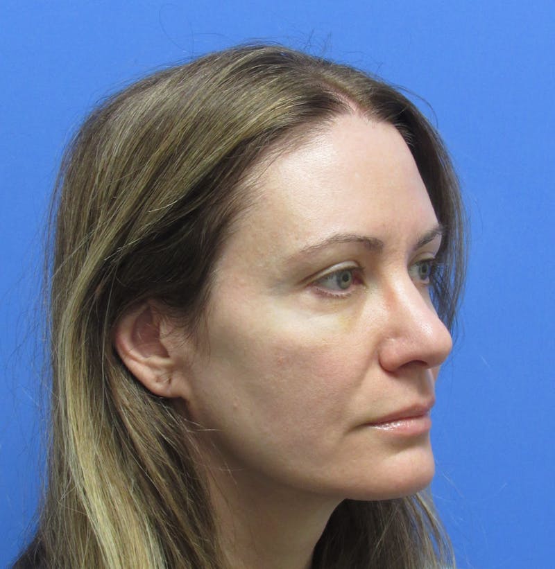 Eyebrow Transplant Before & After Gallery - Patient 277590 - Image 5