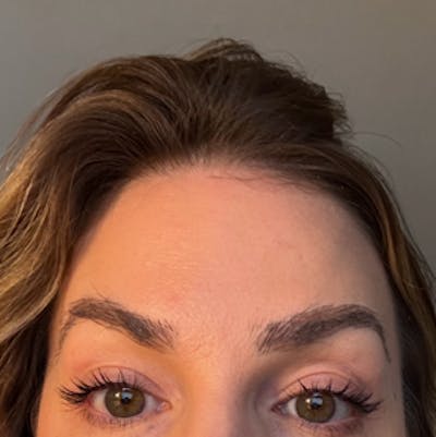 Eyebrow Transplant Before & After Gallery - Patient 178463 - Image 2