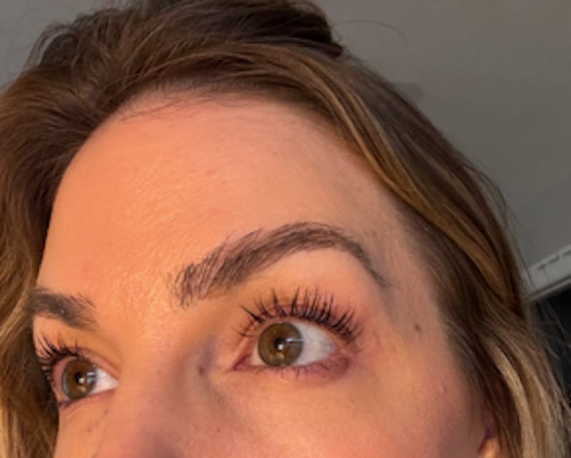 Eyebrow Transplant Before & After Gallery - Patient 178463 - Image 4