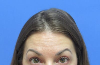 Eyebrow Transplant Before & After Gallery - Patient 178463 - Image 1