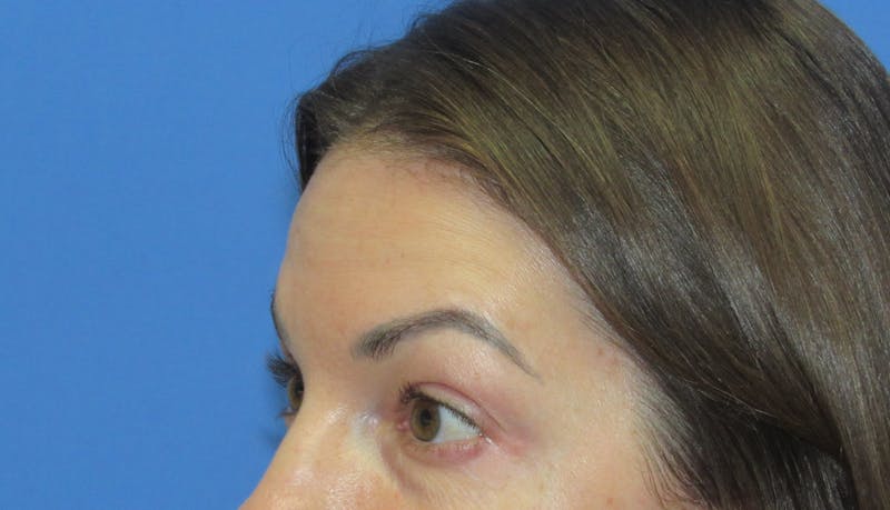 Eyebrow Transplant Before & After Gallery - Patient 178463 - Image 3
