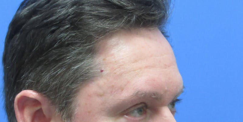 Eyebrow Transplant Before & After Gallery - Patient 268945 - Image 1