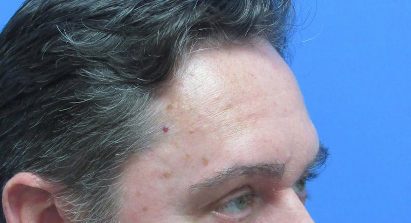 Eyebrow Transplant Before & After Gallery - Patient 268945 - Image 2