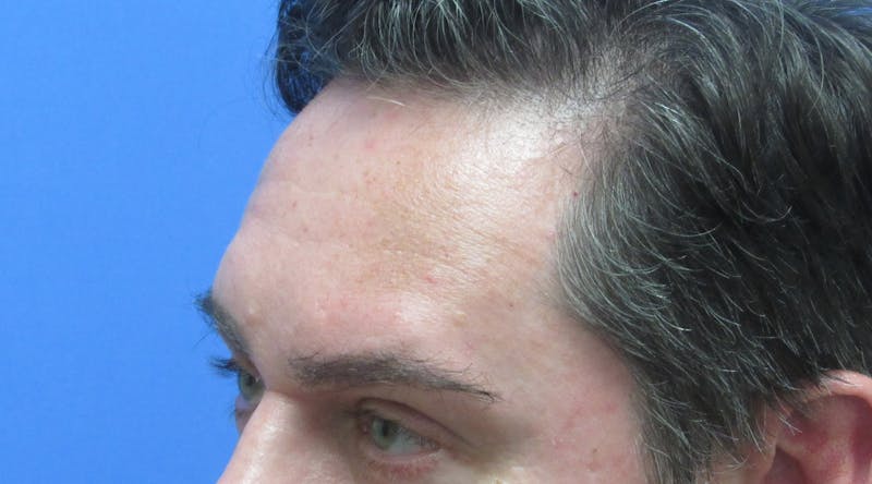Eyebrow Transplant Before & After Gallery - Patient 268945 - Image 4