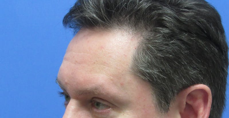 Eyebrow Transplant Before & After Gallery - Patient 268945 - Image 3