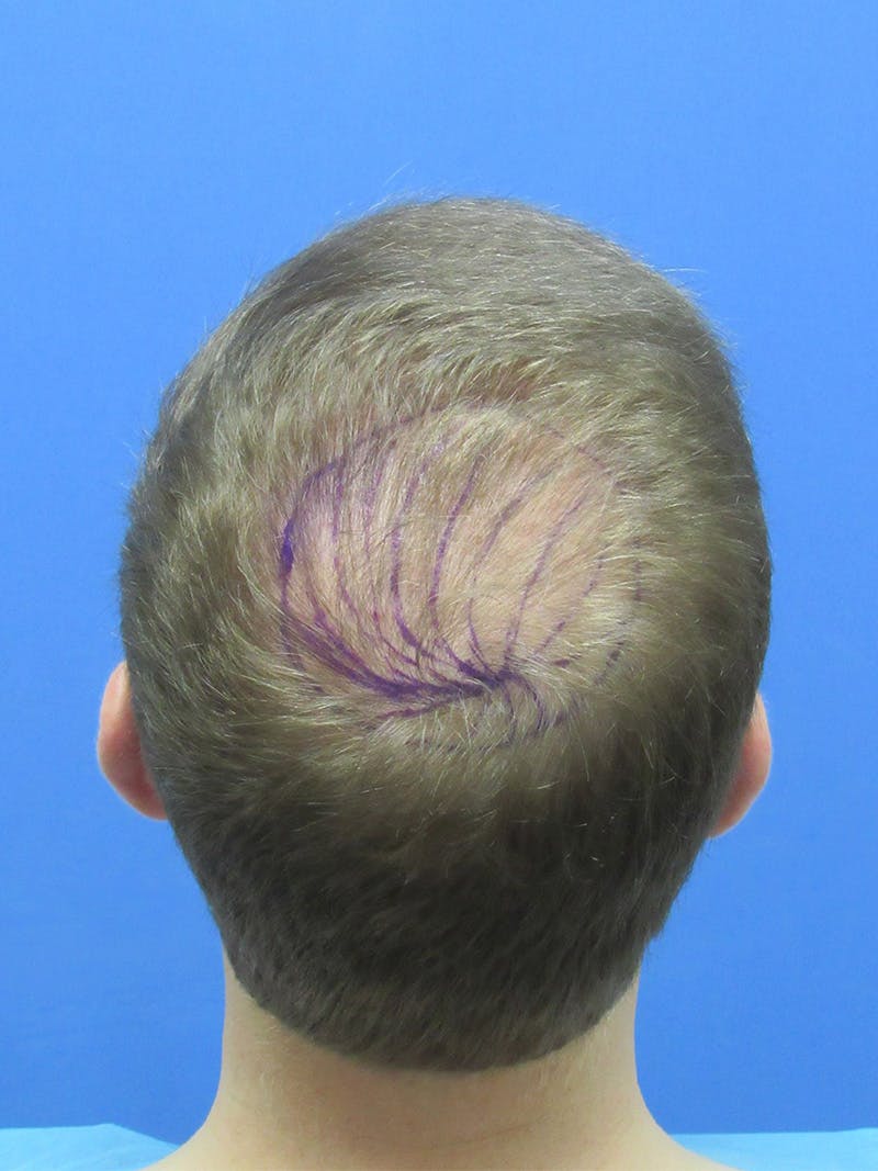 Male Hair Transplant Before & After Gallery - Patient 839830 - Image 1