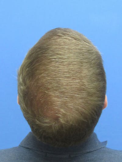 Male Hair Transplant Before & After Gallery - Patient 839830 - Image 2
