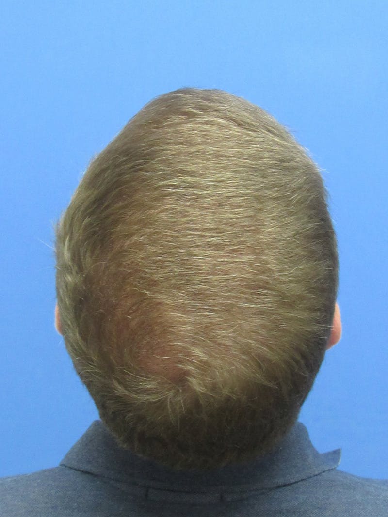 Male Hair Transplant Before & After Gallery - Patient 839830 - Image 2