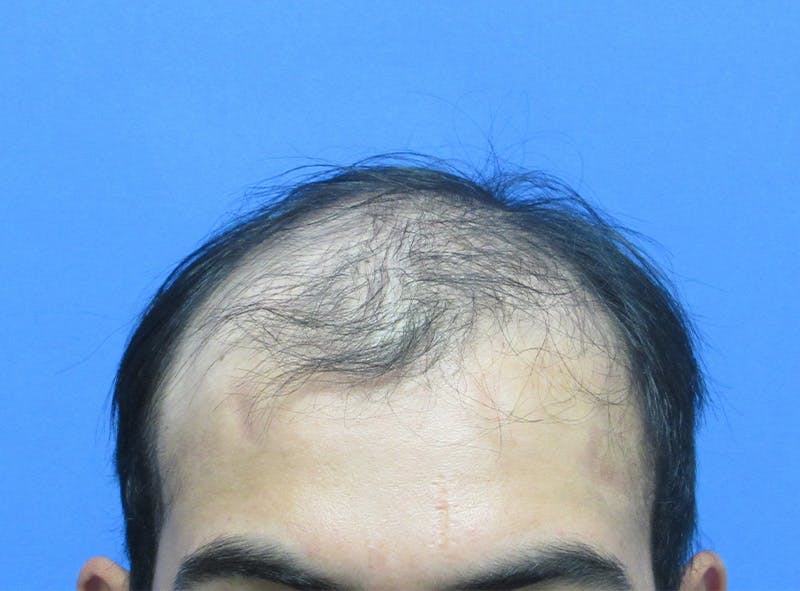 Male Hair Transplant Before & After Gallery - Patient 411161 - Image 3