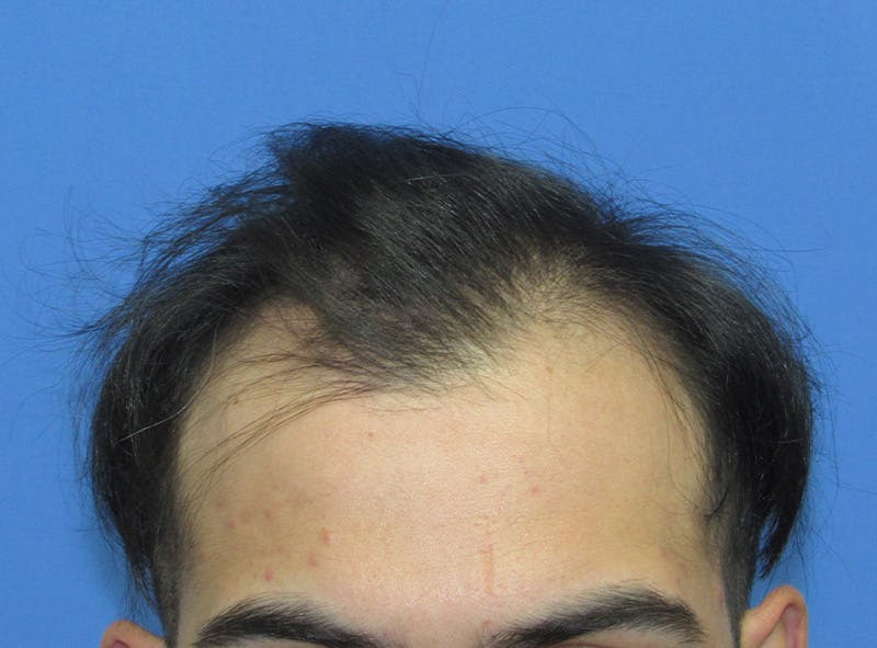 Male Hair Transplant Before & After Gallery - Patient 411161 - Image 4