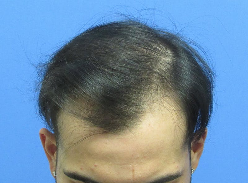 Male Hair Transplant Before & After Gallery - Patient 411161 - Image 2