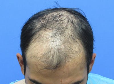 Male Hair Transplant Before & After Gallery - Patient 411161 - Image 1