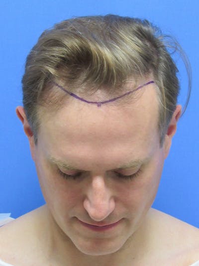 Male Hair Transplant Before & After Gallery - Patient 288585 - Image 1