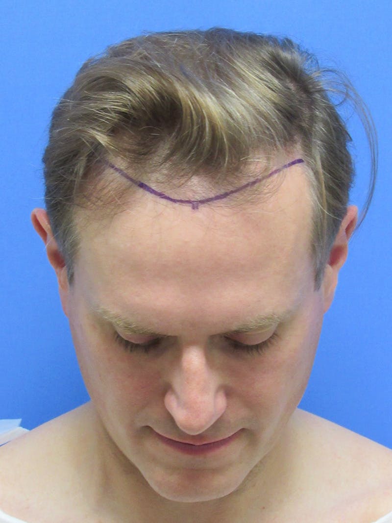 Male Hair Transplant Before & After Gallery - Patient 288585 - Image 1