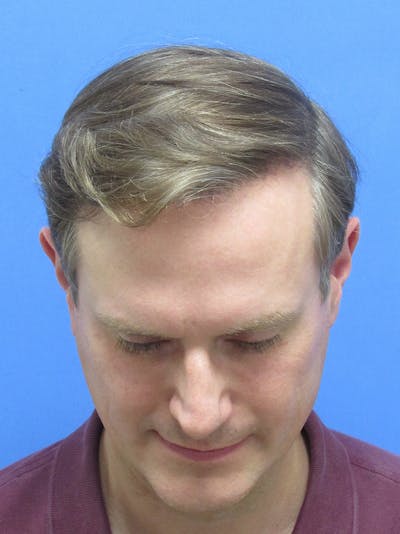 Male Hair Transplant Before & After Gallery - Patient 288585 - Image 2